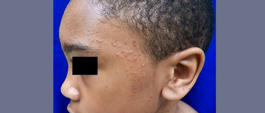 Practical Pearls in Pediatric Skin of Color (Part 1)